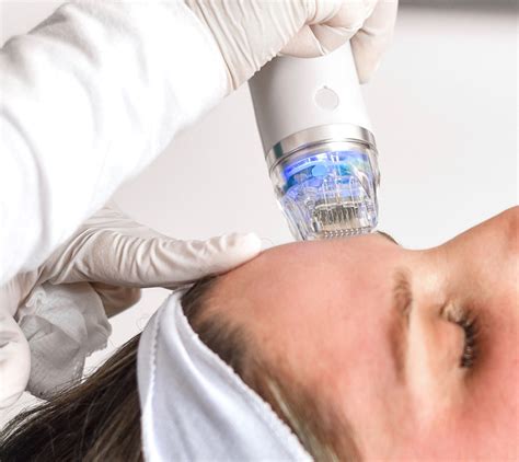 RF microneedling provides stunning results on its own, but it can also be combined. . Rf microneedling near me groupon